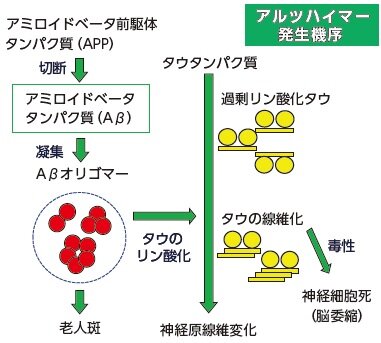 アルツハイマー新薬「アデュカヌマブ」 根本治療となるか